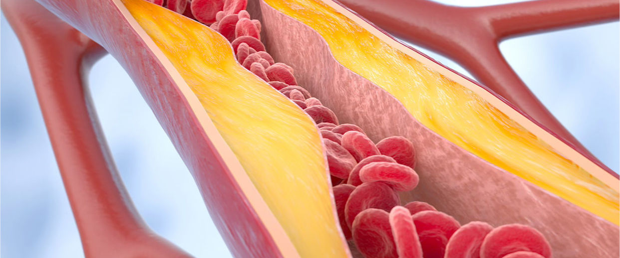 Colesterol alto: o inimigo silencioso que mora em você
