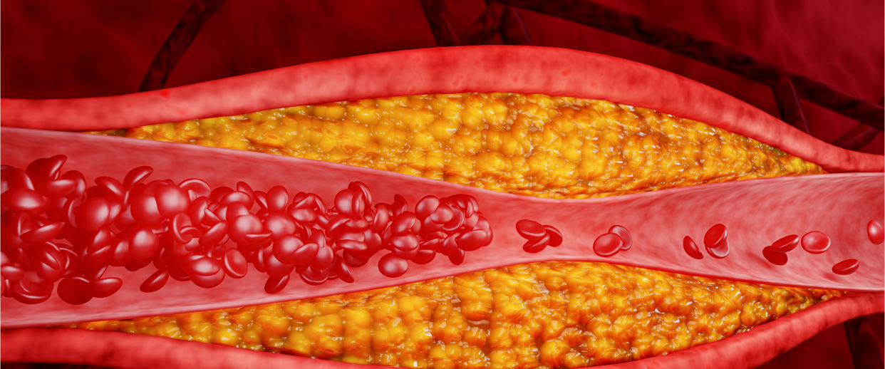 Colesterol HDL: o herói que limpa suas artérias